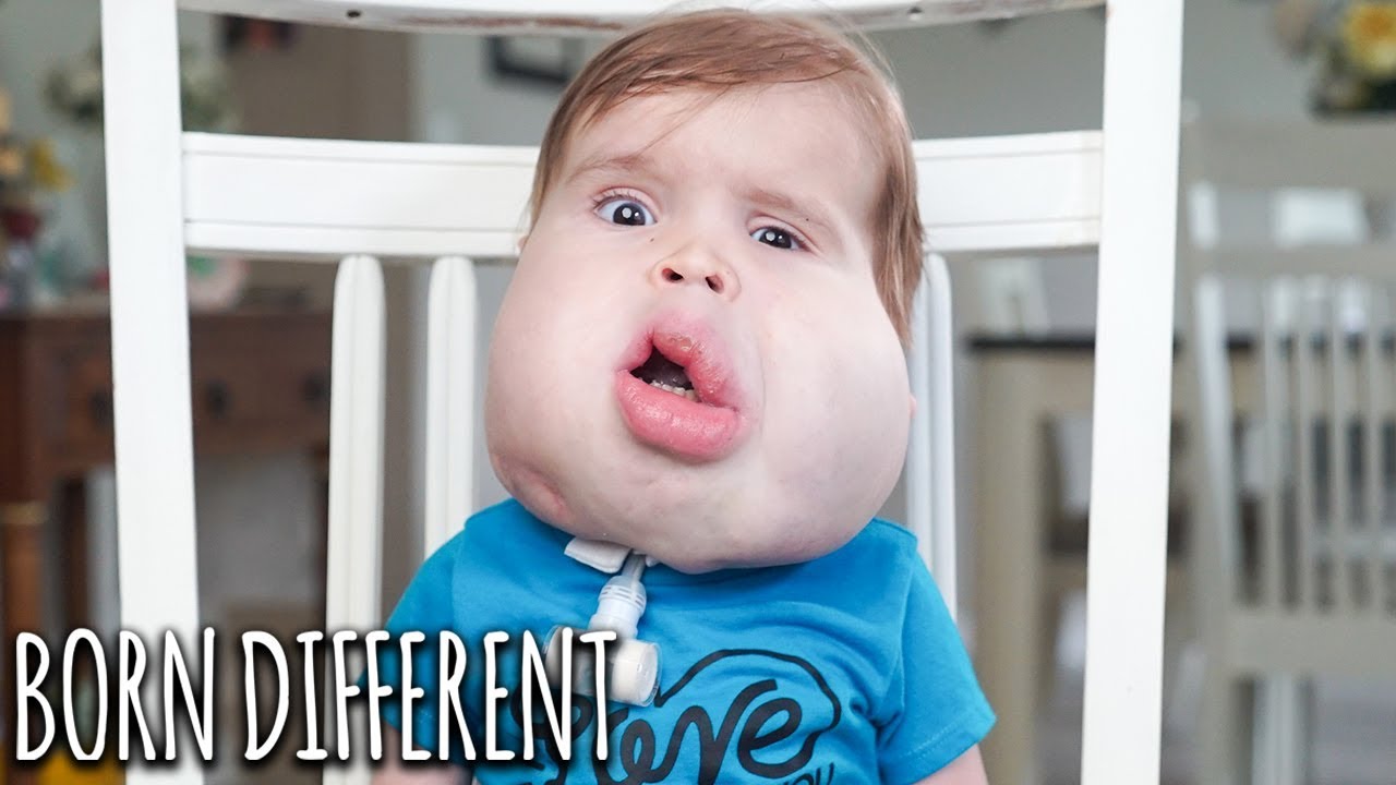 Gavin: Our Little Boy With Facial Cysts | BORN DIFFERENT