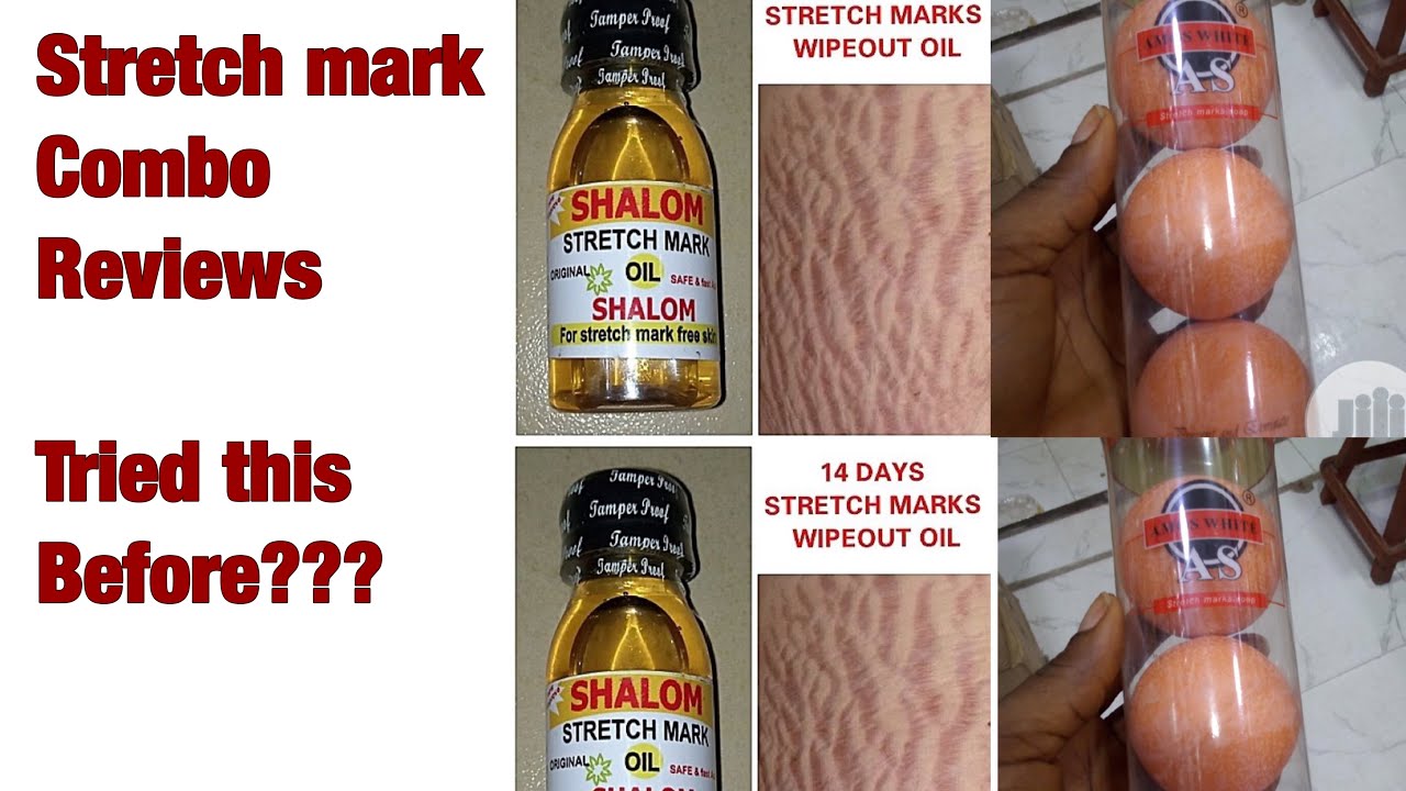 shalom stretch mark removal