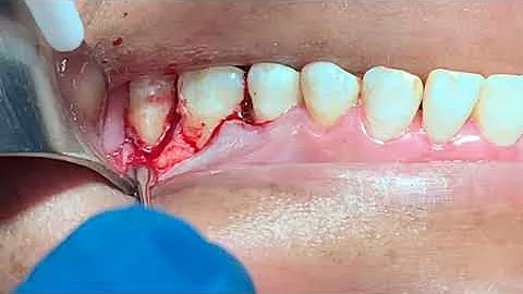 Como tratar a bolsa periodontal?