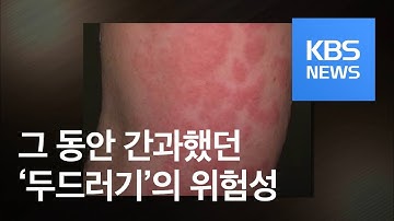 [5분 건강 톡톡] 부푸는 ‘두드러기’… 6주 이상 지속되면 ‘경고’ / KBS뉴스(News)