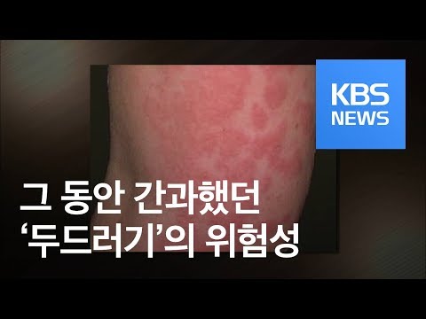   5분 건강 톡톡 부푸는 두드러기 6주 이상 지속되면 경고 KBS뉴스 News