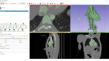 Fast marching segmentation in 3D Slicer