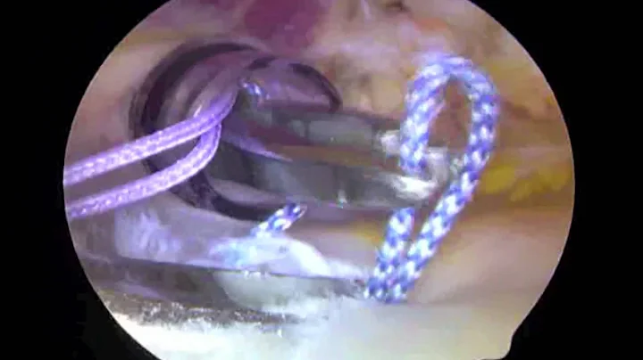 Small Arthroscopic Rotator Cuff Repair with Subacr...