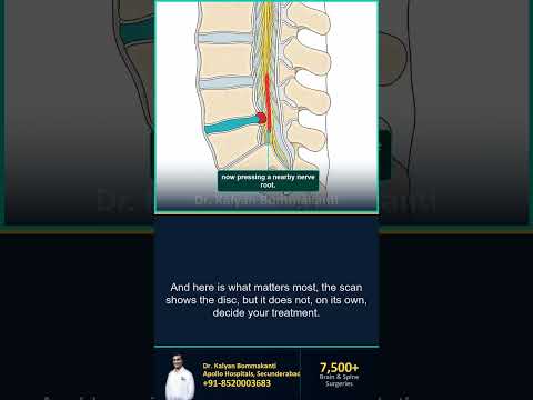 Your MRI Says Slipped Disc — Do You Need Surgery? — Best Endoscopic Spine Surgeon, Hyderabad