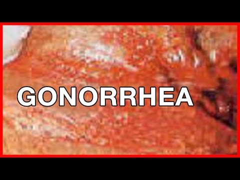 What Is Gonorrhea? What Are Symptoms And Signs Of Gonorrhea?