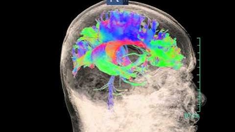 Whole brain and diffusion tensor imaging (DTI) 3D tractography