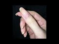 reverse clubbed thumb; get a long slender thumb with long and narrow thumb nail