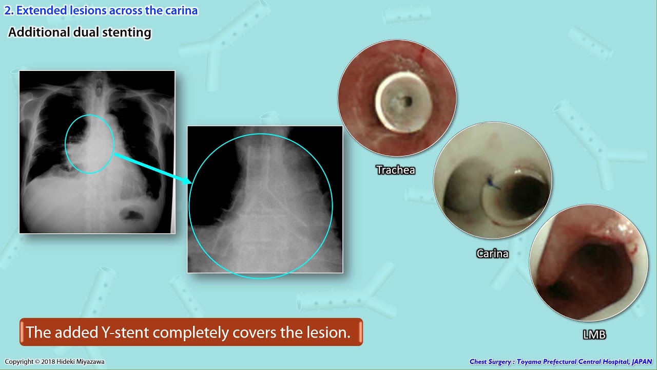 Safe and Easy Placement of Silicone Stent YouTube