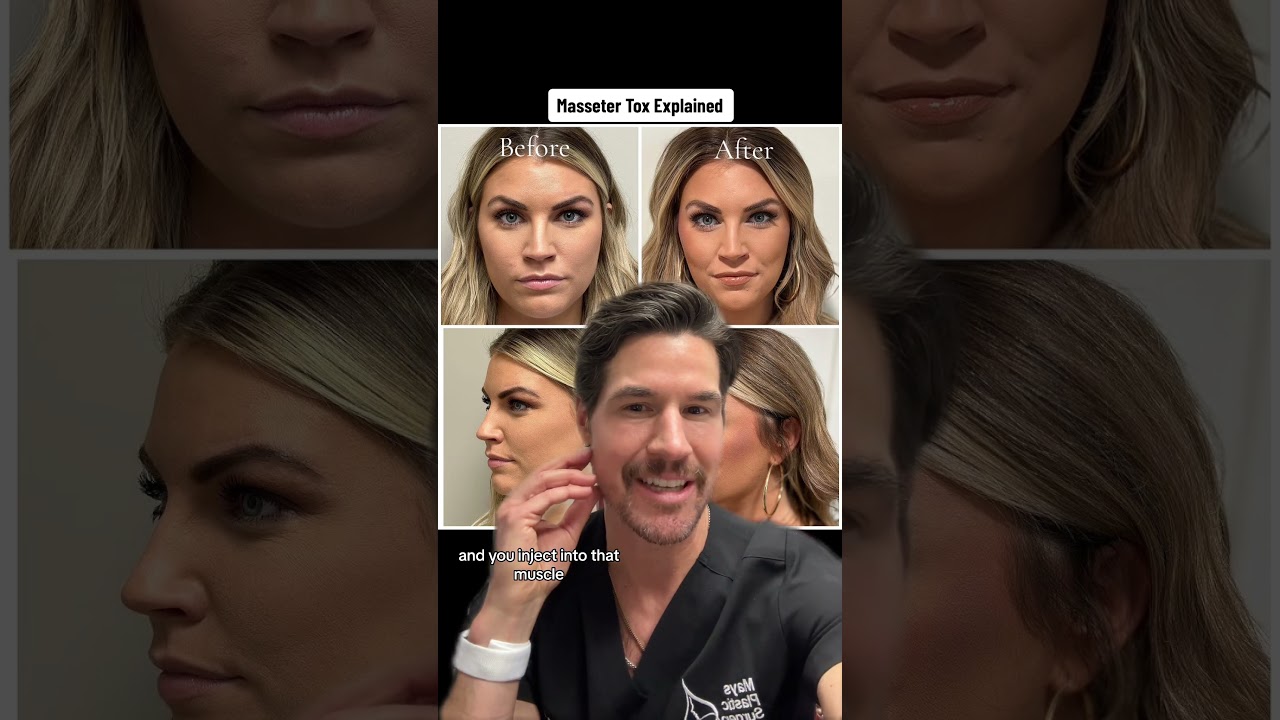 Masseter Botox with Dr. Chet Mays