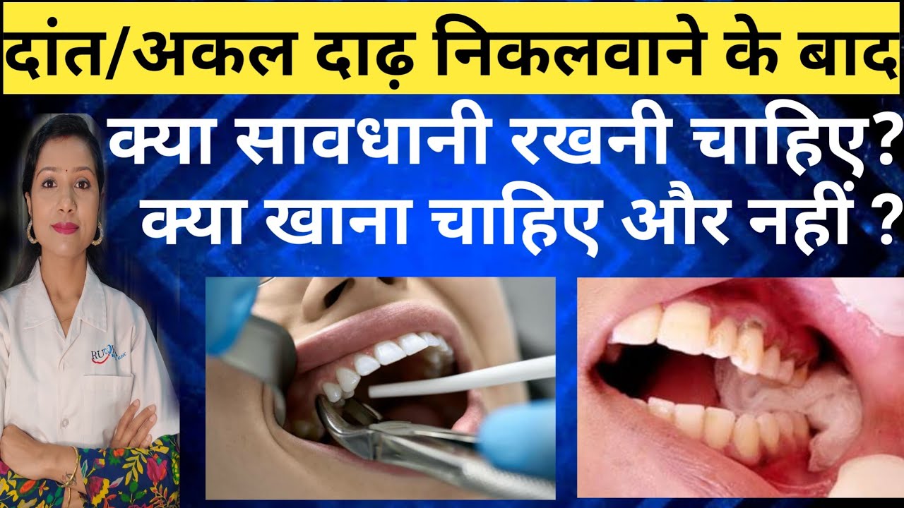 दांत निकालने के बाद क्या करें |Dat Nikalne Ke Baad Kya Khaye |Teeth Removed After Care |Tooth Remove