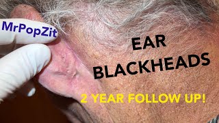 Ear blackhead extractions 2 year follow up of my most viewed video. 1st video linked below