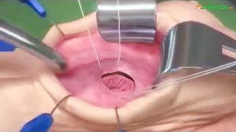 Kỹ thuật mới điều trị rối loạn cương dương tại BV Bình Dân