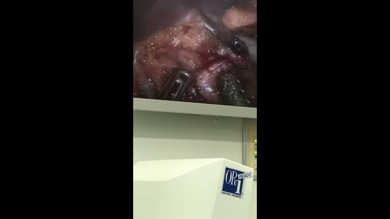 Hepatoduodenal ligament dissection- Proper Hepatic Artery