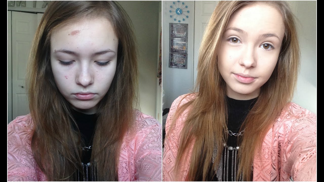 How To Conceal Like A Pro! (How To Cover Burns, Acne , Dark Circles