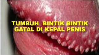 OBAT BINTIK KUTIL GATAL DI PENS || TUMBUH  BINTIK BINTIK GATAL DI KEPAL PENIS