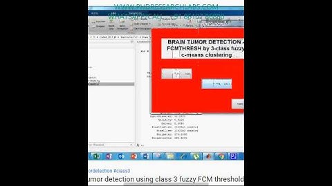 Brain tumor detection using class 3 fuzzy FCM threshold -MATLAB SIMULINK PHD RESEARCH