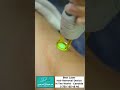 BEST DEVİCE -CANDELA - DR LANA BEAUTY CLINIC  - 0 750 165 48 48