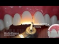 Anterior All Ceramic Crown Prep ACC For Dental Students