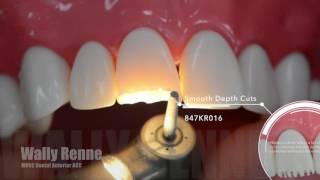 Anterior All Ceramic Crown Prep ACC For Dental Students