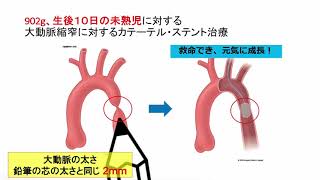 2021年改訂版 先天性心疾患、心臓大血管の構造的疾患（structural heart disease）に対するカテーテル治療のガイドライン