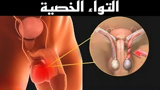 ماذا يحدث عند التواء الخصية | مشاهد تعرض للمرة الاولي