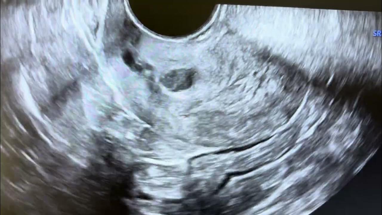 10-mm-endometrial-thickness-in-65-year-female-youtube