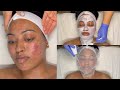 CYSTIC ACNE TREATMENT | WALK-IN FACIAL FOR GRADE 3 AND 4 ACNE  WITH PRO TIPS | LICENSED ESTHETICIAN