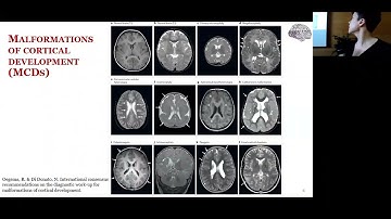Precision cortical imaging: disentangling sources of variability to better model neurodevelopment...