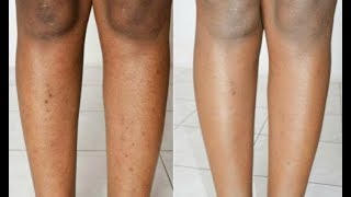 Pernas como remover cicatrizes contusões e das