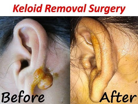 Ear Pinna Keloid Removal