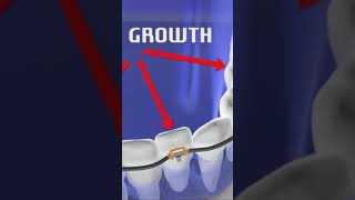 Fastbraces Technology Bone Growth