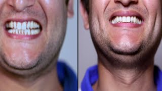 Download lagu How to get pearly white smile