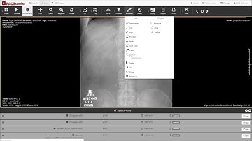 PACScenter - Cobb Angle