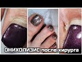 ОНИХОЛИЗИС после хирурга😒педикюру 2 МЕСЯЦА😍БЛЕСТЯЩИЕ ногти🎊ПЕДИКЮР с РЕМУВЕРОМ♥️кусачки Silver Star💣