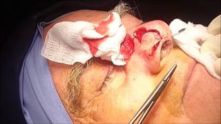 Bilobed flap for nasal reconstruction