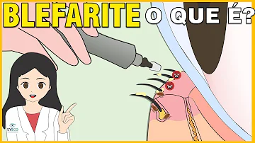 Come curare definitivamente la blefarite?
