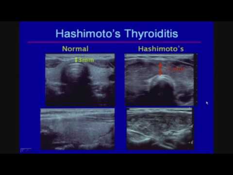 Video: Diffuse Changes In The Thyroid Gland - Causes, Treatment