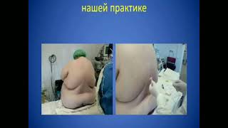 Эпштейн С Л Периоперационная эпидуральная анестезияанальгез Эпштейн С Л Периоперационная эпидуральная анестезияанальгез