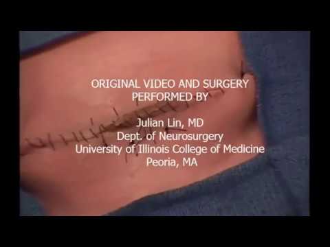 Surgical Simulation of Myelomeningocele Repair (spina bifida cystica)