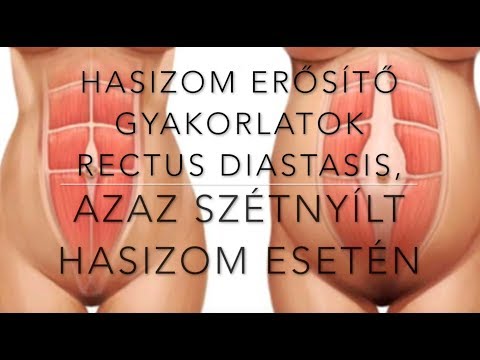 Hasizom erősítése Rectus Diastasis, azaz szétnyílt hasizom, esetén