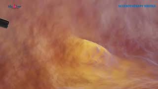 Sclerotherapy Needle