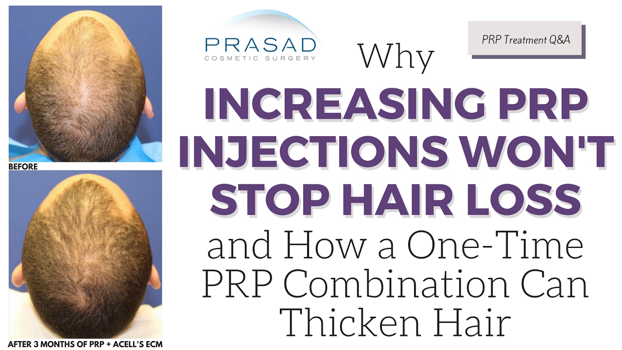 Why Increasing PRP Injections Won't Stop Hair Loss, and One-Time Treatment  to Thicken Hair - YouTube