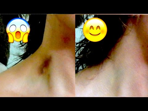 How to Cover a Hickey in Less than 5 Minutes - YouTube