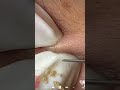 Skincare | Blackheads Removal #694 #tweezers skincare #blackheads blackheads