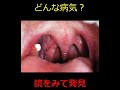 【扁桃膿栓】喉にある白いのは何ですか? #shorts