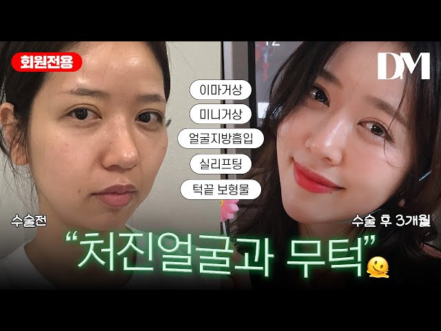처진 볼살, 마시마로 처럼 처진 눈, 쑥 들어간 무턱의 변화!!  갸름하고 선명해지나까 훨씬 이쁨!           #미니거상 #이마거상 #처진눈