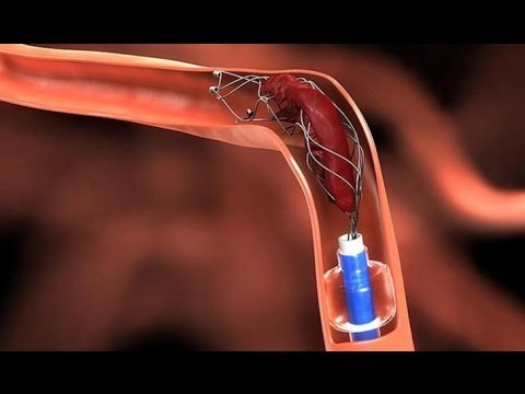 الجلطات الخطر الصامت