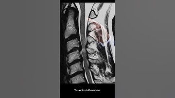 Exploring Cervical Spine MRI: Revealing Soft Tissues and More #shorts