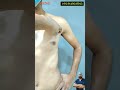 Gynecomastia Result | Chest Fat Transformation | Gynecomastia reduction excercise