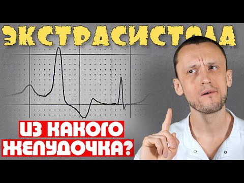 Из какого желудочка ЭКСТРАСИСТОЛА ? Желудочковая экстрасистолия